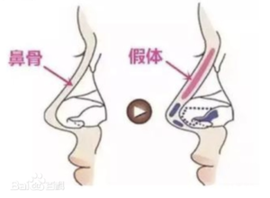 prosthesis